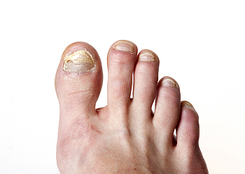 Are Your Cracked Heels a Sign of Thyroid Disease? — The Foot & Ankle Center  Of Maryland