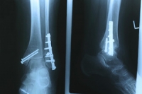ORIF for an Ankle Fracture
