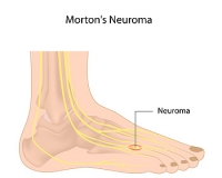 Location of Pain Caused by Morton’s Neuroma
